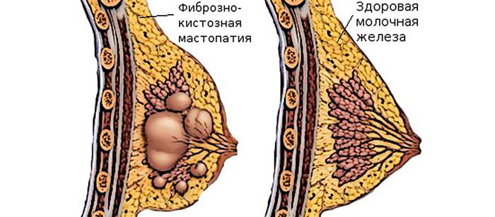 Kopūstų lapai su mastopatija: kaip teisingai taikyti? Mastopatija: gydymas su liaudies preparatais namuose