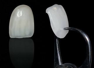 Keramikiniai vainikėliai ant priekinių dantų