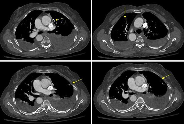 Plaučių CT tyrimas - moderni diagnostika