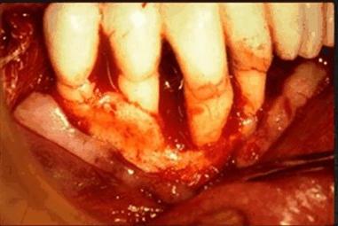Kodėl dantenas dingo nuo danties ir kaip jį grąžinti į vietą