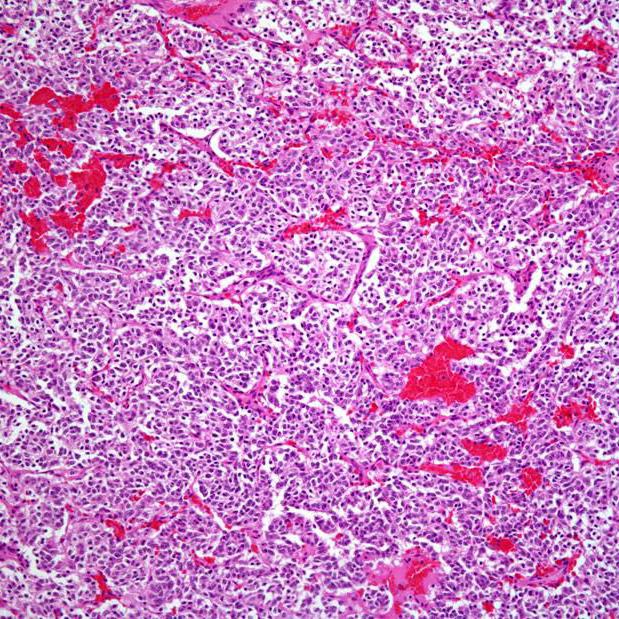 Smulkialąstelinis plaučių vėžys: diagnozė, gydymas, prognozė