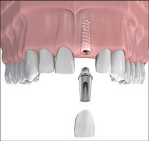 Kiek kainuoja vienas dantų implantas šiuolaikinėse klinikose?