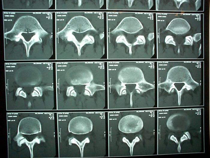 Stuburo tomografija - šiuolaikinė nugaros skausmo diagnostika