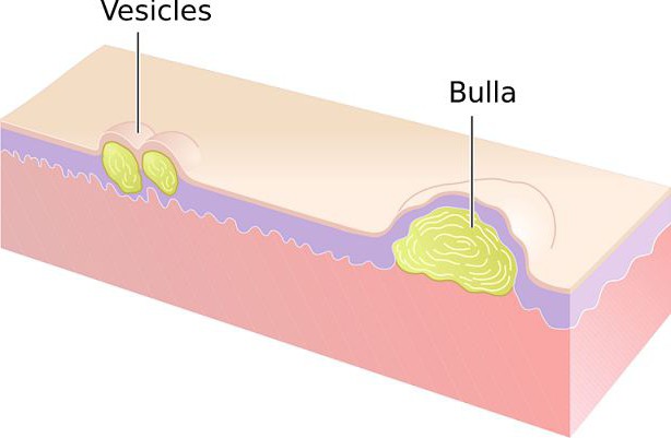 vesicles tai